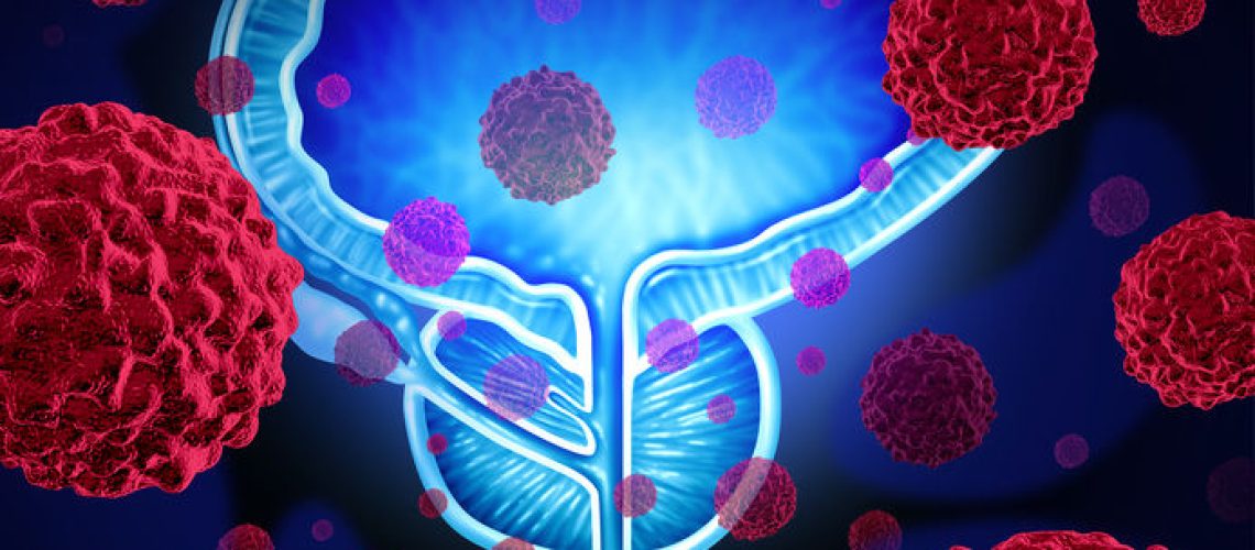 Tumor benigno de próstata