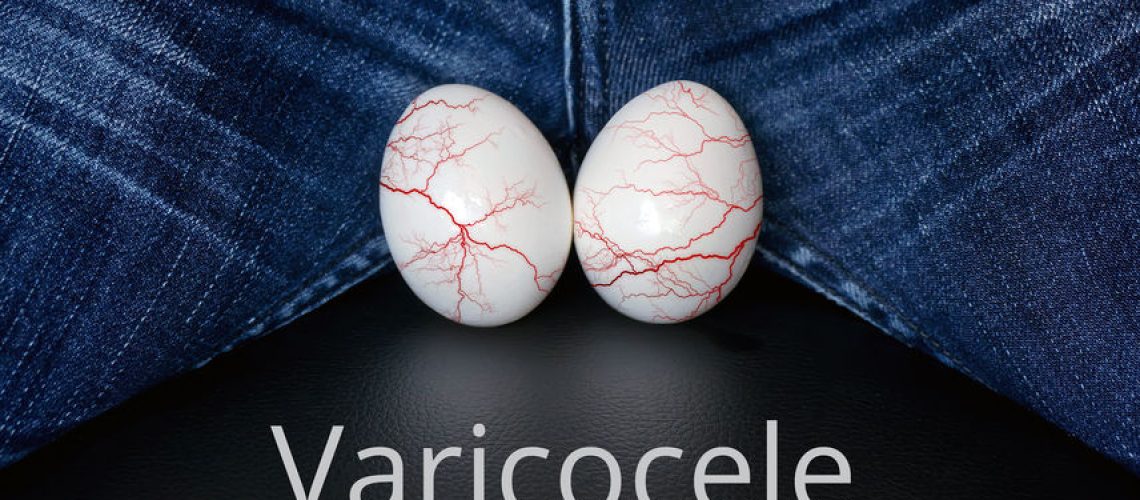 Varicocele