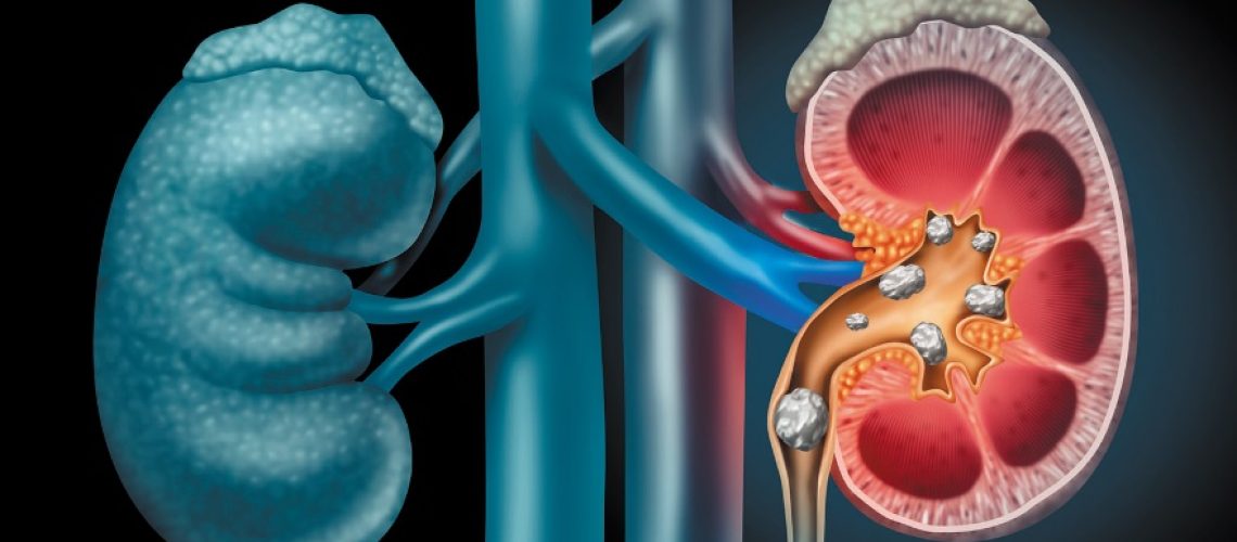 cirurgia de cálculo renal