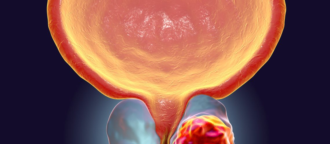 Câncer de próstata